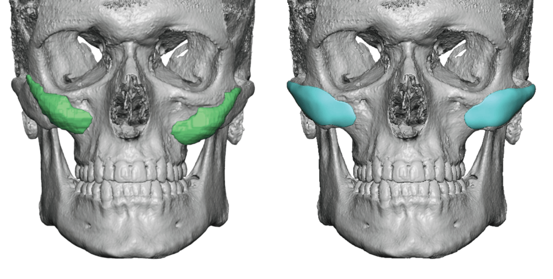 The Compact Midface Advantage